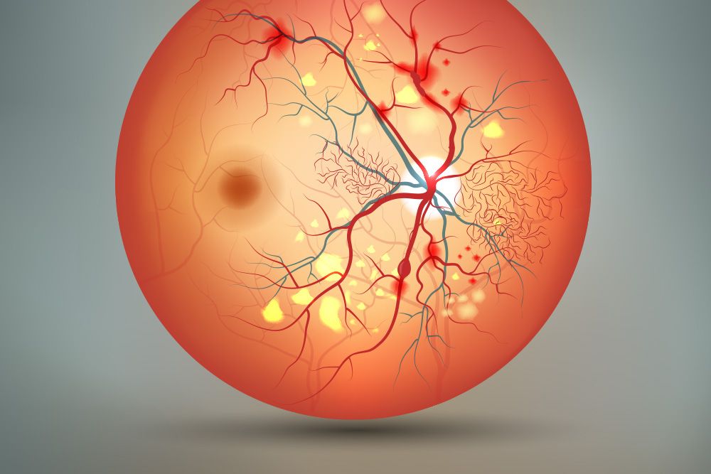 Restricted blood vessels in the eye that can cause vascular eye disease.