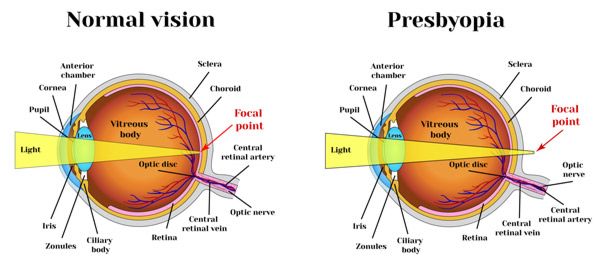 presbyopia